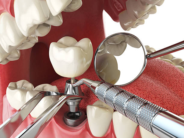 Tooth Infection Emergency Dentist in MI